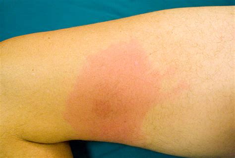 erythema migrans pronunciation|erythema migrans pictures in child.